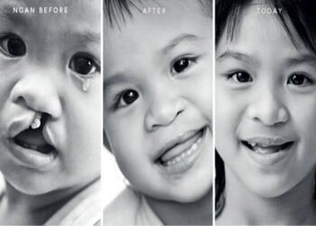 [HỖ TRỢ TRUYỀN THÔNG] – CHƯƠNG TRÌNH PHẪU THUẬT SỨT MÔI, HỞ HÀM ẾCH 2018 (MIỄN PHÍ)